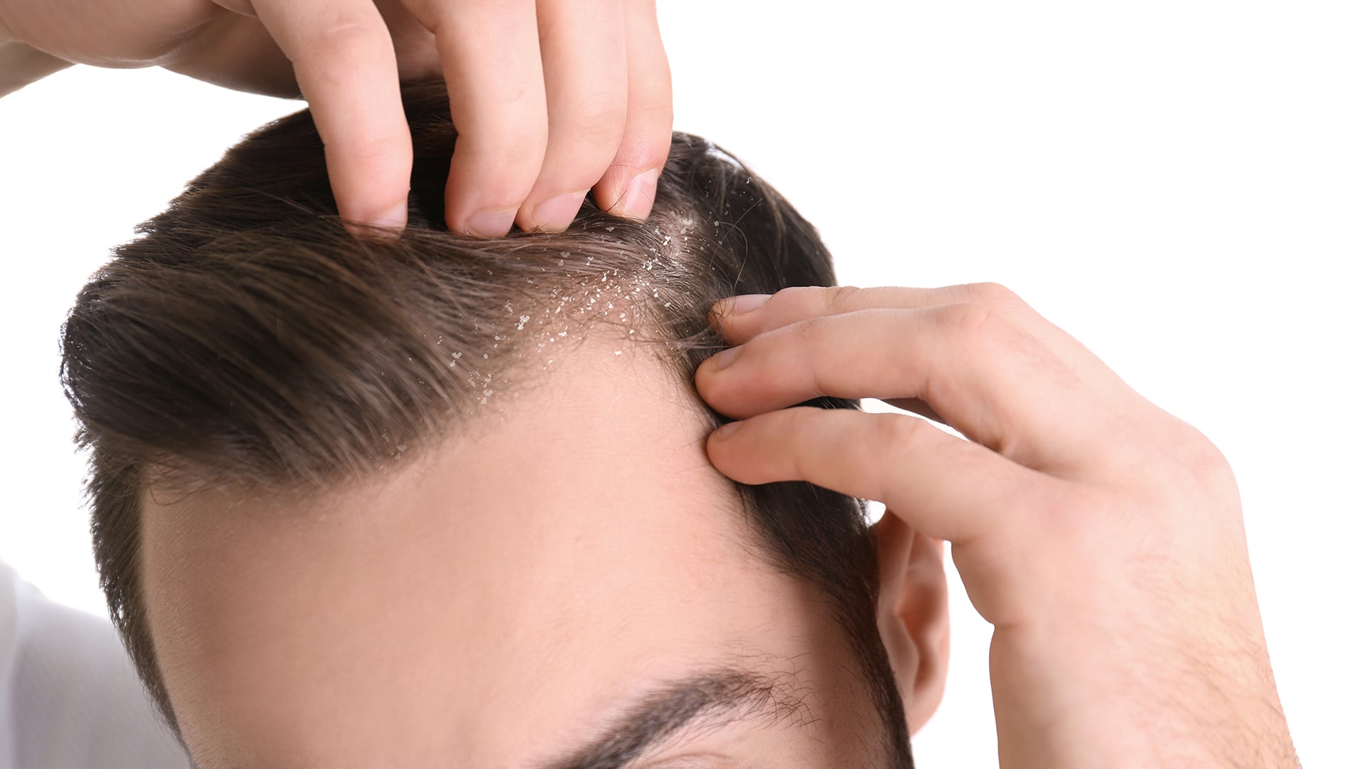  DESCUBRE LA MEJOR MANERA DE PREVENIR LA CASPA